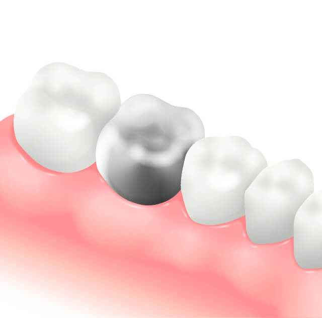 メタルクラウン(金属冠)